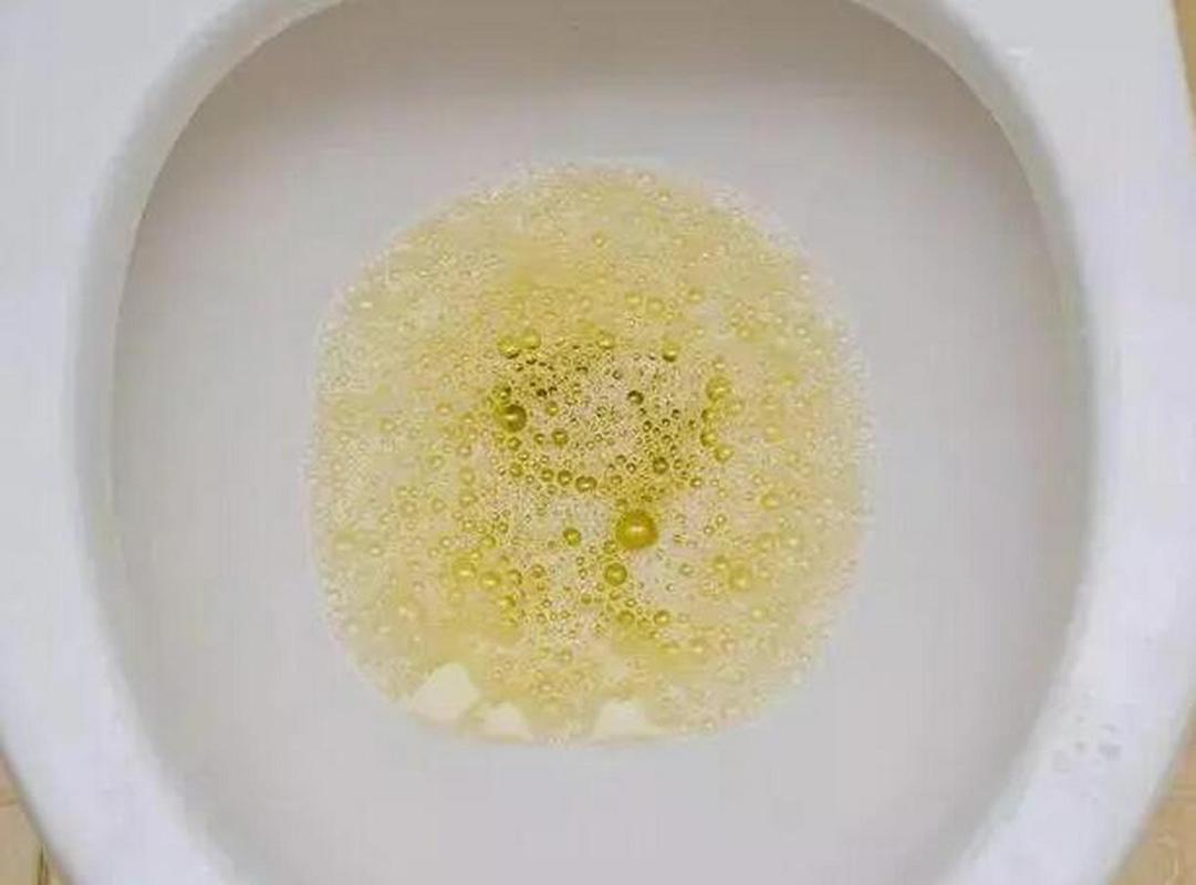 男士排尿有泡沫是什么原因
